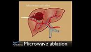 NOW WE'RE COOKING!! MICROWAVE ABLATION OF LIVER TUMOUR