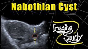 Nabothian Cyst || Ultrasound || Case 70