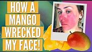 I Thought I Was Allergic to Mango | Mango Mouth | Recovery Progress Pictures