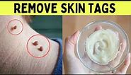 How to remove skin tags painlessly from eyelids in one night at home