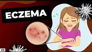 Eczema: Everything You Need To Know