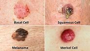What Are the Different Types of Skin Cancer?