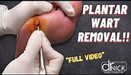 How Plantar Warts are Removed | Office Surgery | Dr. Nick Campitelli