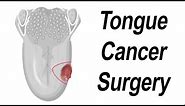 Surgical Removal of Tongue Cancer Animation