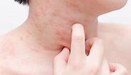 Skin Rashes In Children: Causes And Treatment
