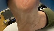 Watch Podiatrist Debride Wart After Salicylic Acid Treatment | Hard Skin Removal with Docpods
