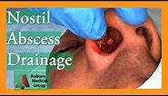 Nostril Abscess Drainage | Auburn Medical Group