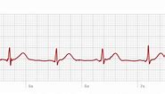 A look at the Apple Watch’s ECG, from someone who needs it