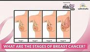 What are the stages of breast cancer