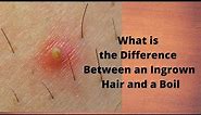 What is the Difference Between an Ingrown Hair and a Boil
