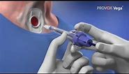 Helping Restore Speech After Laryngectomy: Complete Guide to Provox Vega Voice Prosthesis Insertion.