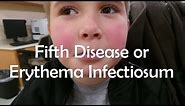 Fifth Disease or Erythema Infectiosum