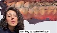 How to get predictable all on x cases every single time? Does it make any difference if we scan preop? Do we need to capture tissue and details when scanning preop for all on x cases? In this video, I will guide you through 3 tips to help you improve your preop scanning technique and accuracy. #allonxtips #allon4implants #dentaltips #intraoralscan | Evident