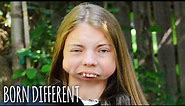 I Was Born Without A Jaw | BORN DIFFERENT