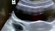 Left Adnexal Simple Cyst #ultrasound #shortvideo #shorts