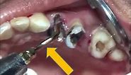 Piezo assisted grossly decayed maxillary teeth removal