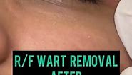 Wart removal on Eyelid|how to get rid of warts|Dermatologist in Chandigarh |Dr Ashima Goel| Mohali