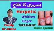 Herpetic Whitlow Finger Treatment in Homeopathic
