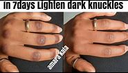 Apply This On Dark Knuckles Everyday For 7days See Wow Results || How To Lighten Dark Knuckles fast