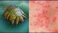 What is Scabies? Causes, Pictures Images Signs and Symptoms of Scabies