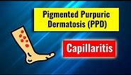 Pigmented purpuric dermatosis, Capillaritis: overview, clinical features, histology and management