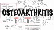 Osteoarthritis Overview (causes, pathophysiology, investigations, treatment)