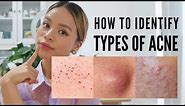 How to treat EVERY type of acne (With Pictures )