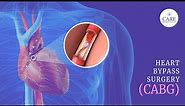 How is Coronary Artery Bypass Graft (CABG) Surgery Done? | Heart Bypass Surgery