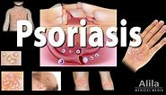 Psoriasis: Types, Symptoms, Causes, Pathology, and Treatment, Animation