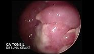 Carcinoma Tonsil | Video Laryngoscopy