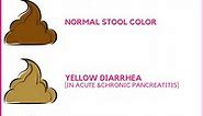 9 Common Stool Changes with Pancreatitis (With color illustrations). - Oh My Gut