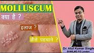molluscum contagiosum | Treatment of Molluscum contagiosum | Homeopathic treatment of Molluscum