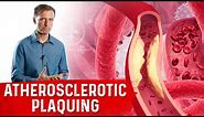 Protocol for Calcified Plaque in Your Arteries – Atherosclerosis – Dr.Berg