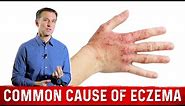 Is Your Eczema Coming from a Salicylate Sensitivity? – Dr. Berg On Atopic Dermatitis
