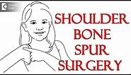 Shoulder Bone Spur Surgery | Causes and recovery - Dr. Mohan M R