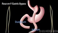 Roux en-Y Gastric Bypass, with Introduction on Body Mass Index, Animation.