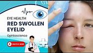 Swollen eyelid |causes |Treatment| Red swollen eyelid