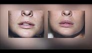 Lip Augmentation Silicone, Fillers, Injectables