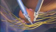 Prostactectomy Procedure Overview - da Vinci Surgical System - Penn State Hershey