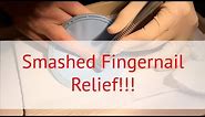 Smashed finger relief!! How to drain blood from under a fingernail...at the dentist's office!