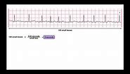 Determine HR from an Irregular-Rhythm EKG | 6-second Method