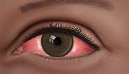 Conjunctivitis: What Is Pink Eye?