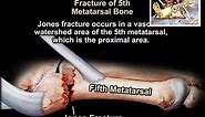 Metatarsal Fractures - Everything You Need To Know - Dr. Nabil Ebraheim