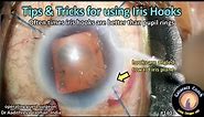CataractCoach 1403: tips and tricks for using iris hooks