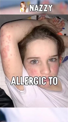 He’s Allergic to WHAT?! 💧🤯 (Norris Nuts)