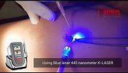 Wart removal using laser