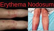 Erythema Nodosum Symptoms, Causes, Diagnosis, Treatment, Infections, Medications