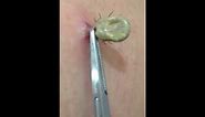 Tick removal by US doctor