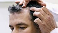 What Is Syphilis Hair Loss And How To Treat It?