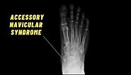 BEST Exercises for Accessory Navicular Syndrome